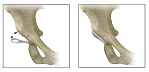  Acetabular Rim Trimming 