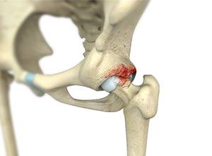  Femoroacetabular Impingement 