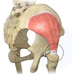  Gluteus Tendon Tear 