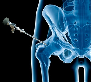  Hip Arthroscopy 