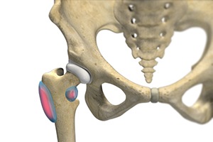  Hip Bursitis 