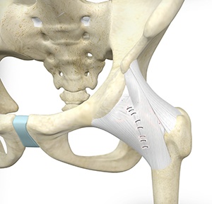  Hip Capsular Closure  