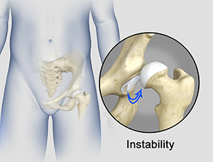  Hip Instability 