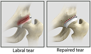  Hip Labral Repair  