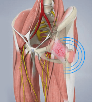  Snapping Hip Syndrome 