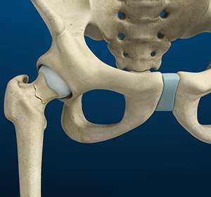  Stress Fractures of the Hip  